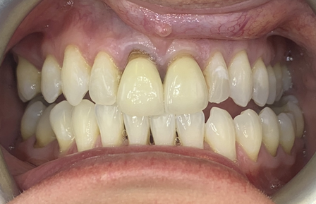 Crowns C1B