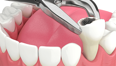 Treatment - Qualitydental